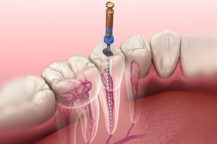 Endodontie4