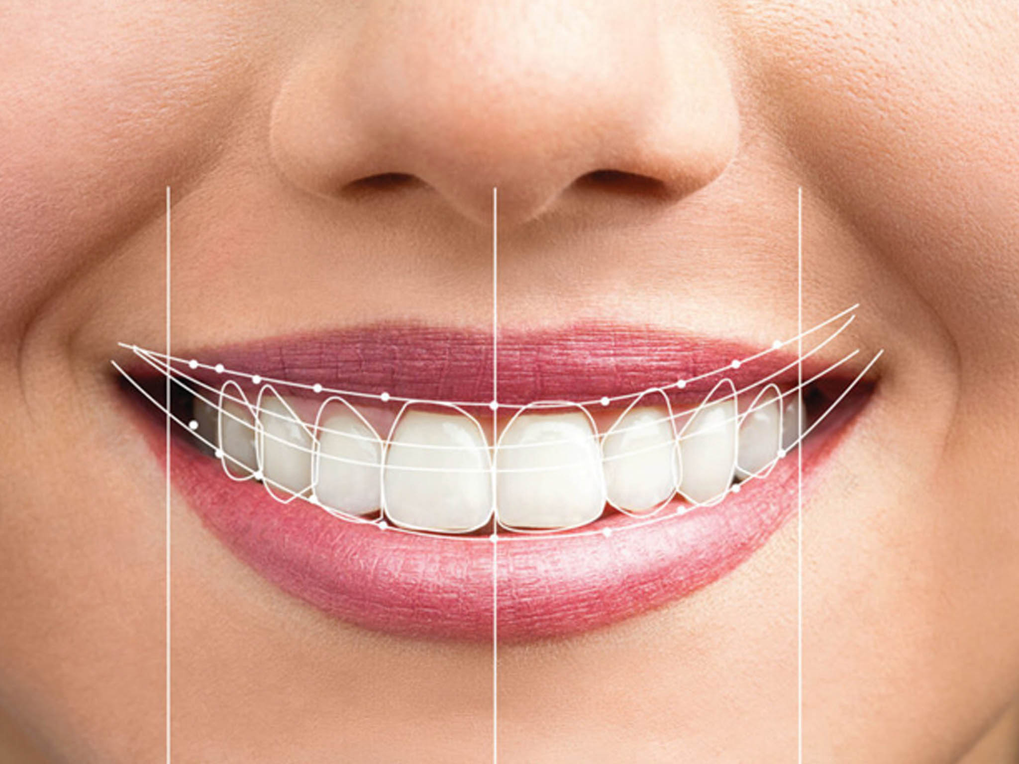 smile-makeover