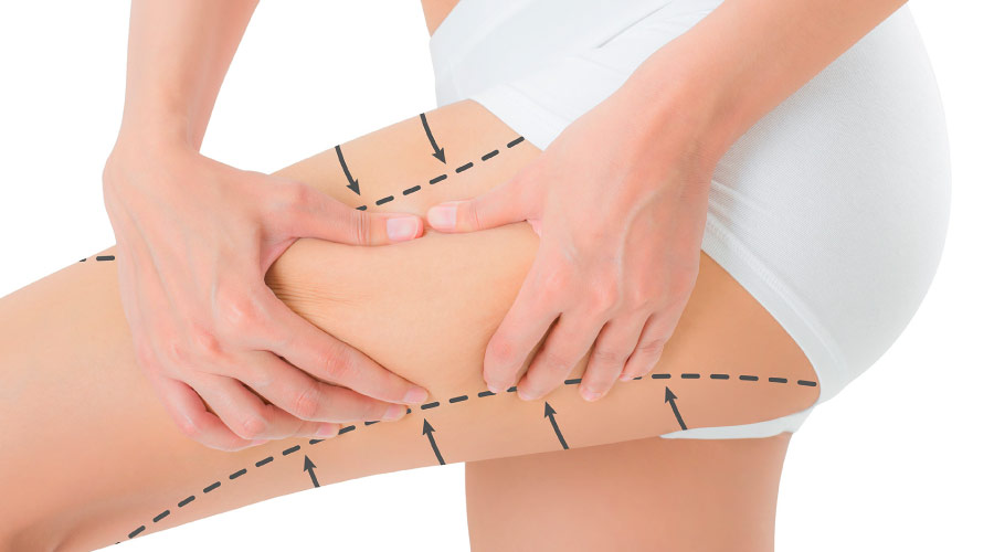 Oberschenkelstraffung-Turkei-MCAN-Health