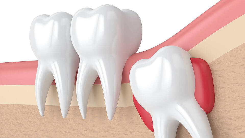 csm_weisheitszahn-op_e28c530097